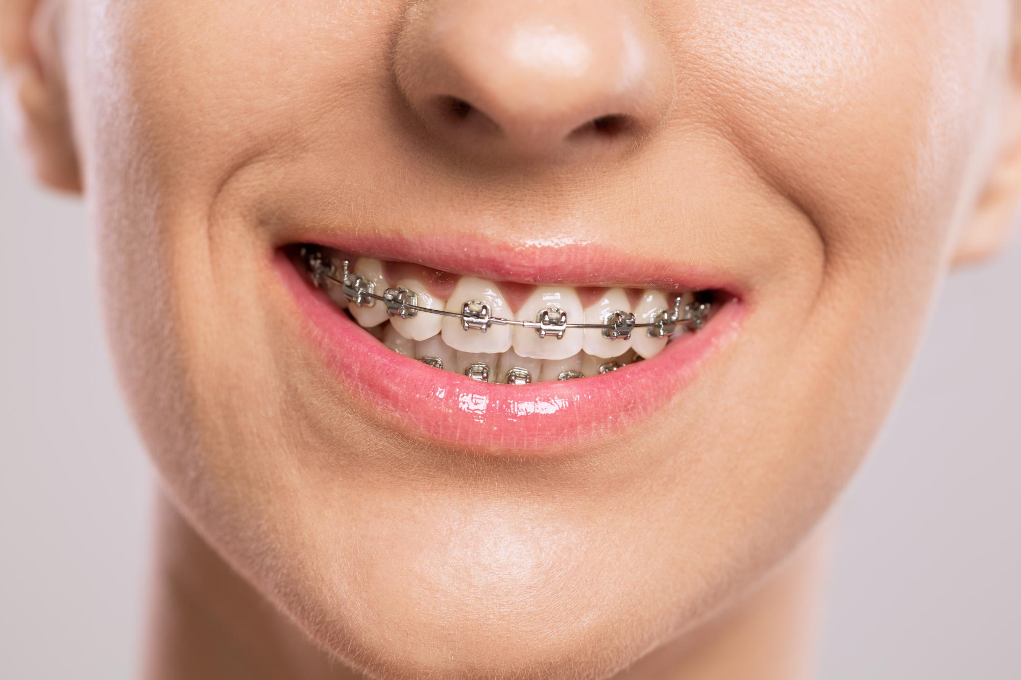 orthodontist mansfield tx